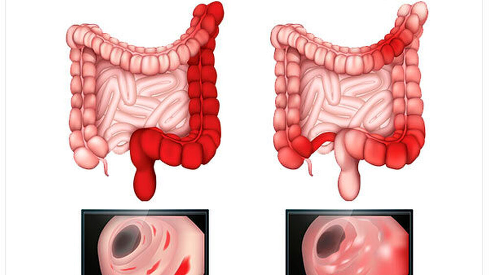 Chronisch-entzündliche Darmerkrankungen: Colitis ulcerosa und Morbus Cron - letzter kann sich auch im Mundbereich manifestieren.
