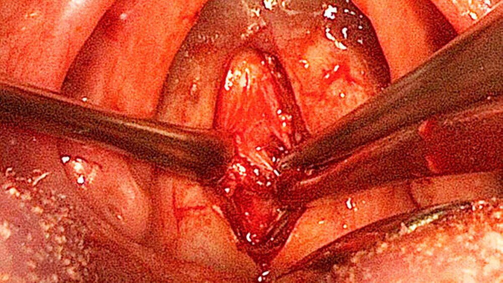 Intraoperative endoskopische Bildgebung: Operativer intraoraler Zugang mit Präparation des Dens axis. Beidseits des Frakturfragments befindet sich die nach lateral verdrängte prävertebrale Halsfaszie. Oberhalb liegt die mittels Naht temporär am Weichgaumen fixierte Uvula, basal ist die Zunge erkennbar. |