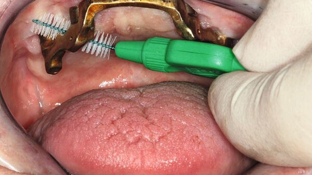 Implantate müssen durch eine Zwischenraumbürste gut gereinigt werden können. |