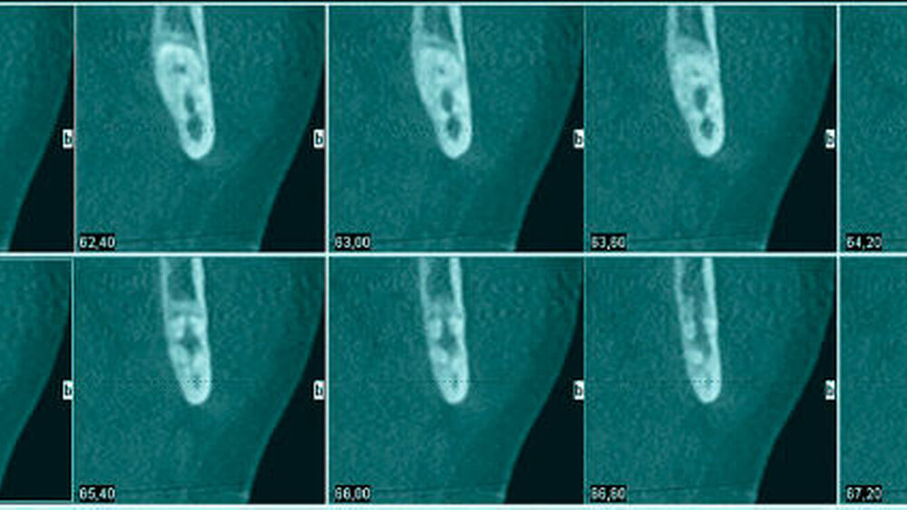 Abbildung 3: In den kleinen sagittalen Schichten in regio 38 von proximal nach distal kommend erkennt man den Verlauf des Nerven in Beziehung zum Zahn 38. Dieser zieht zwischen den Wurzeln des Zahnes hindurch, ohne dass die Wurzeln caudal des Nerven wieder fusionieren. |