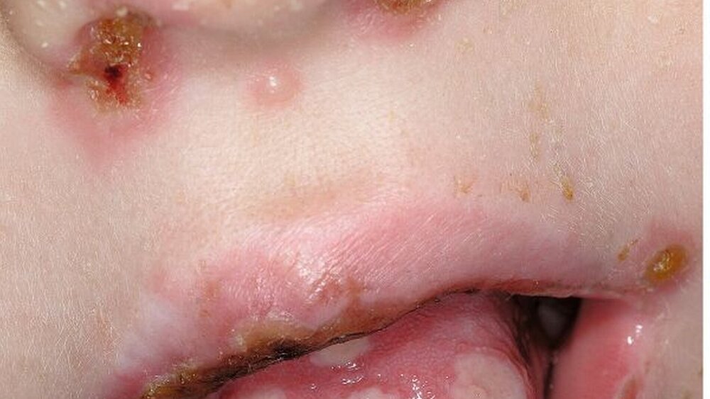 Die Stomatitis ist für ein Kind so schmerzhaft, dass es Essen und Trinken verweigert. |