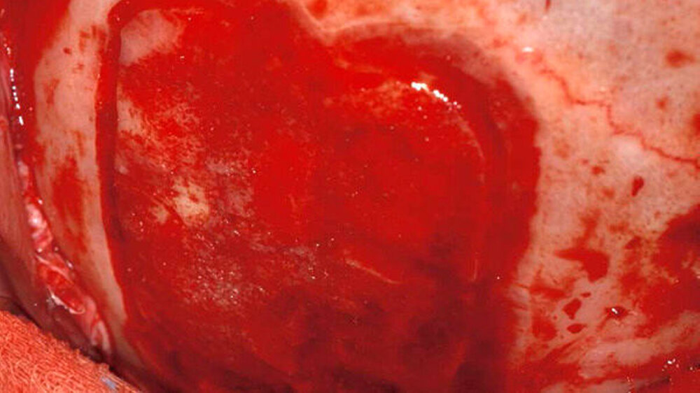 Zur Rekonstruktion der neuen Augenhöhle: Knochenentnahmestelle auf dem Schädelknochen.