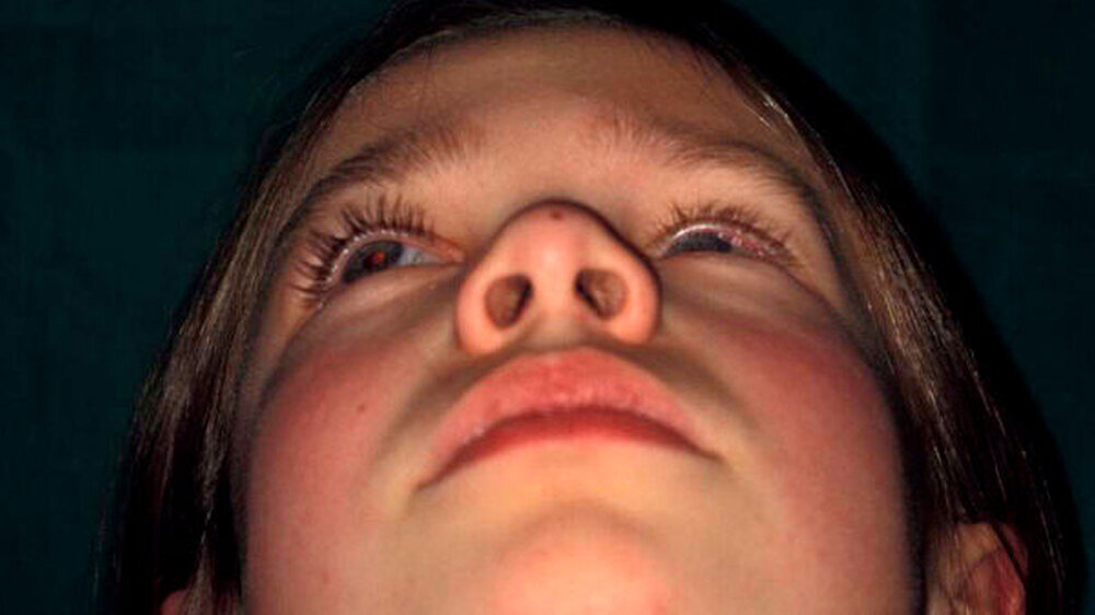 Das "eingesunkene" Auge von unten fotografiert.
