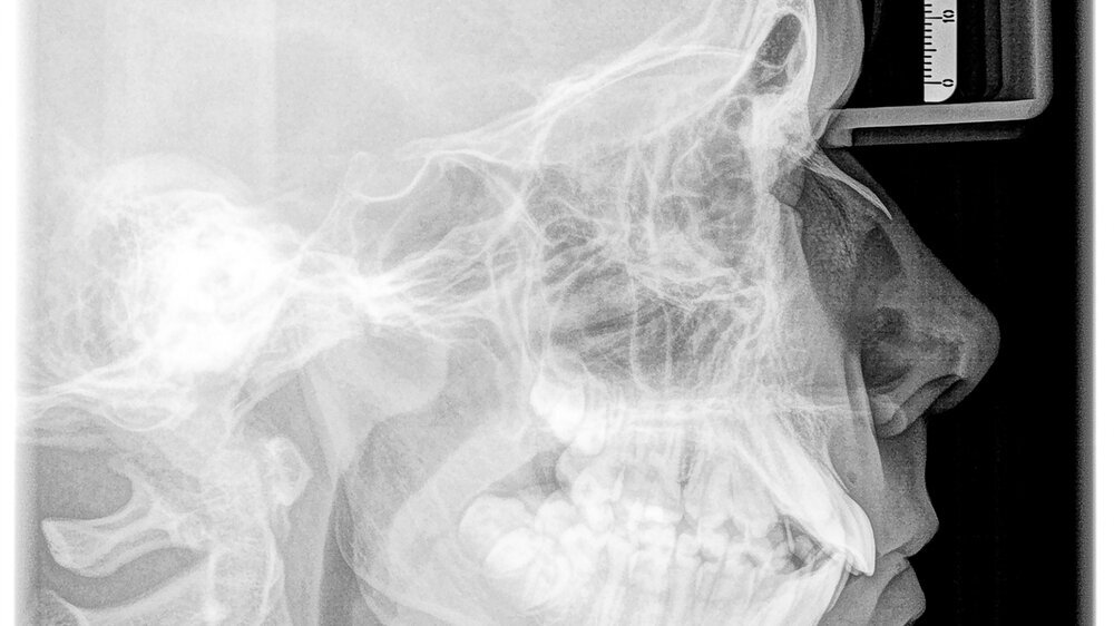 FRS eines jungendlichen Patienten