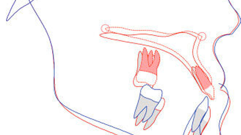 Abbildung 5: OP-Simulation am Fernröntgenseitenbild: Situation prä OP (rot) und post OP (blau) |