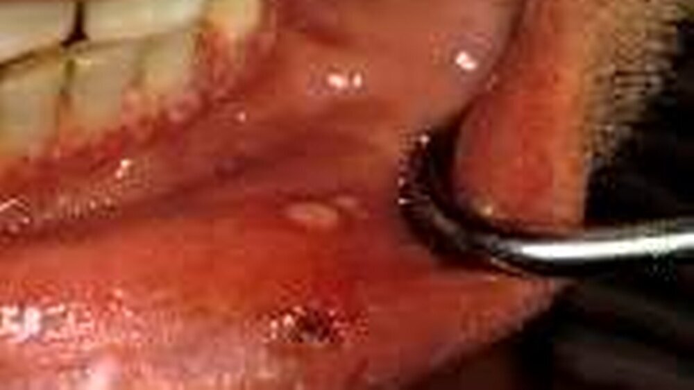 Abb. 1: Gingivostomatitis herpetica im Bereich des marginalen Parodonts und der Unterlippe