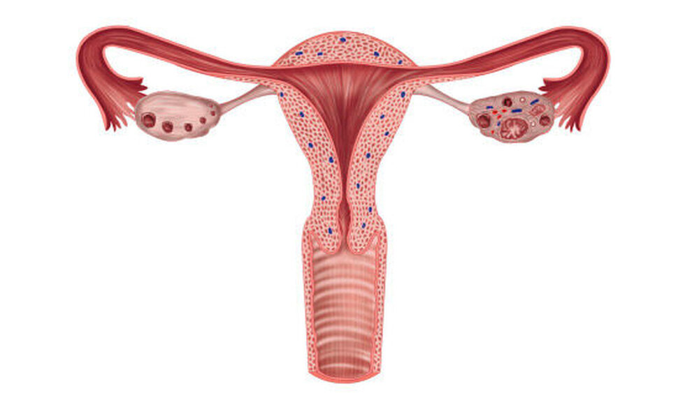 Bei Tumorerkrankungen der Eierstöcke ist zwischen Keimzelltumoren und einem Ovarialkarzinom zu differenzieren. |