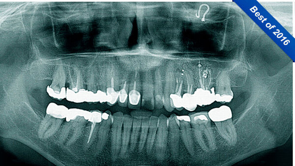 Abbildung 1: radiologischer Ausgangsbefund – PSA |