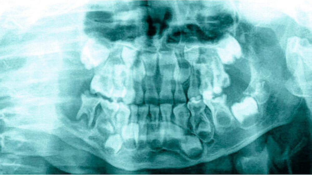 Abbildung 1: Deutliche Knochenauflösung im Unterkieferseitenzahngebiet rechts sowie fehlende Darstellung des Processus articularis im Orthopantomogramm