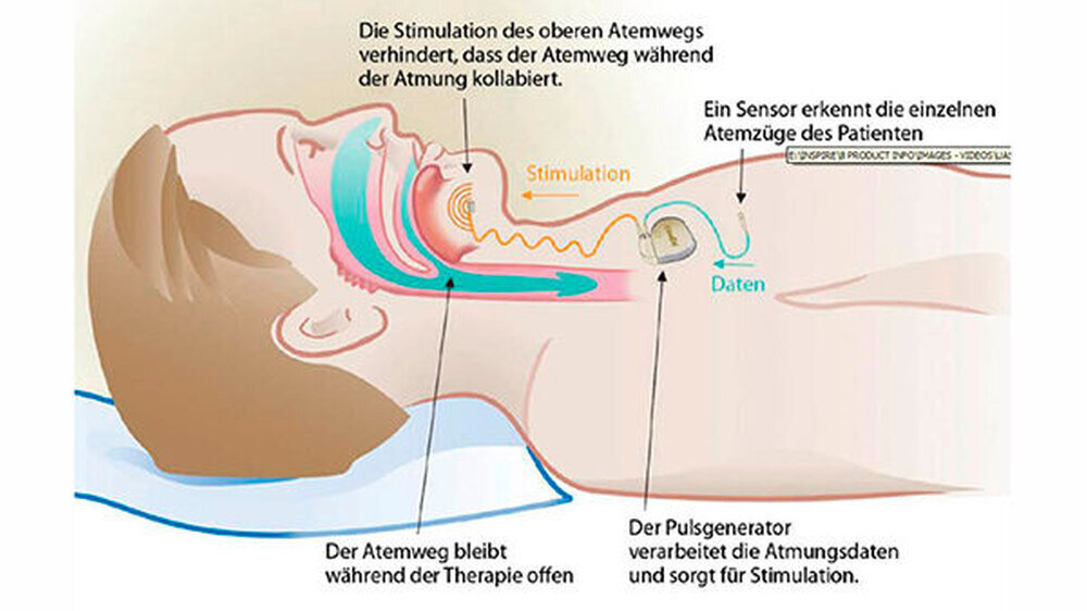 Dieses Schema verdeutlicht die Funktion des Zungenschrittmachers, der an der Universitätsklinik in Jena gegen Schlafapnoe implantiert wurde.\r\n