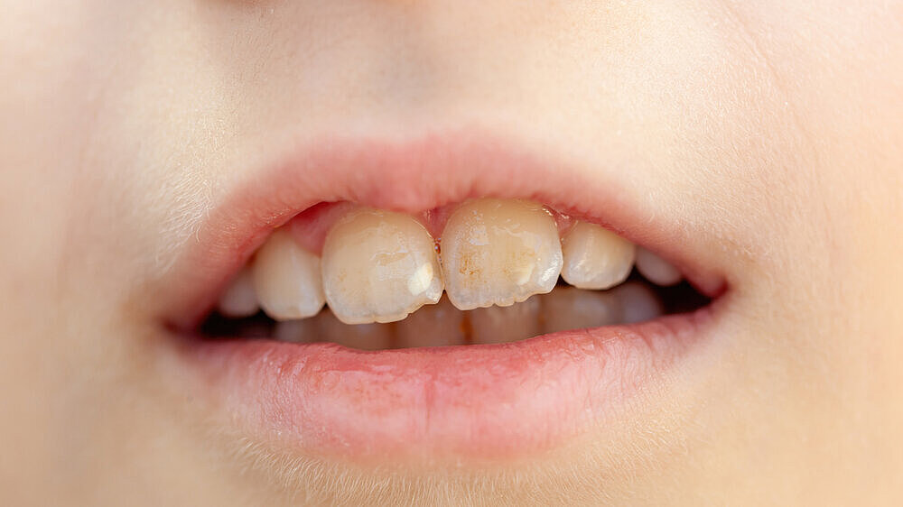 Child showing hypomineralization of teeth, also called molar incisor hypomineralization - MIH - Close up of a child's mouth showing hypomineralization of teeth, a common dental defect affecting the enamel of permanent first molars and incisors, making them more susceptible to decay