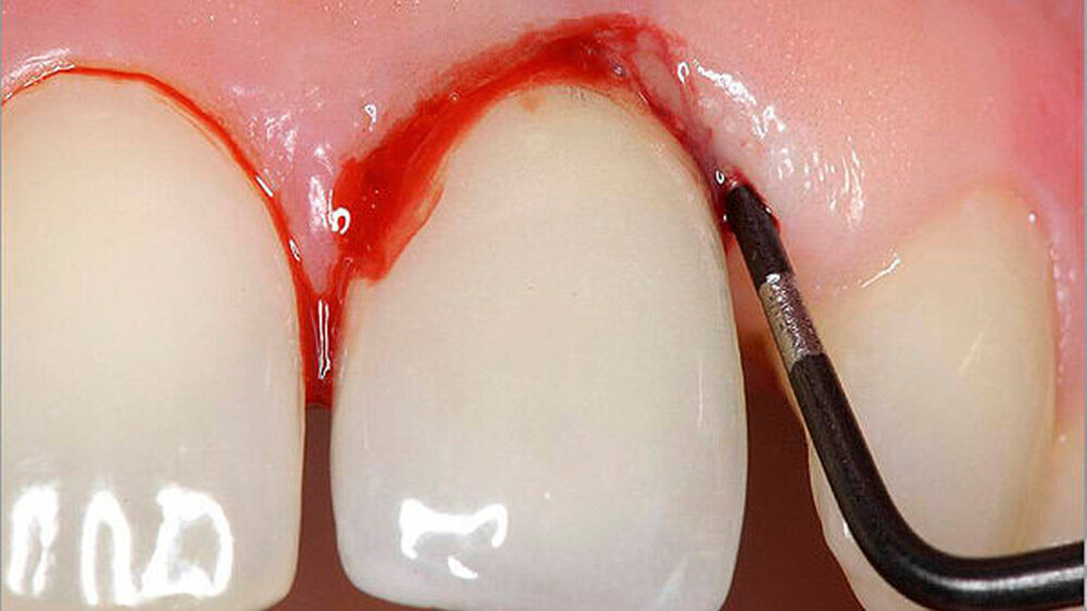 Bleeding on Probing ist ein gebräuliches Untersuchungsverfahren für die Diagnostik der perimplantären Mucositis oder Periimplantitis.| Bleeding on Probing ist ein gebräuliches Untersuchungsverfahren für die Diagnostik der perimplantären Mucositis oder Periimplantitis. |