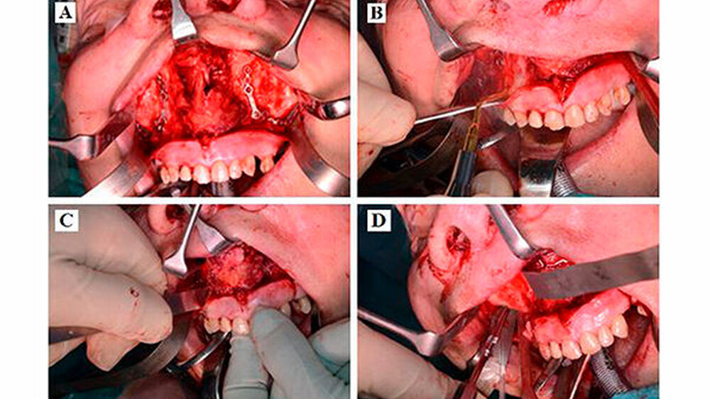 Abbildung 3: A = Anbringen der Osteosyntheseplatten, B = Osteotomie mittels Piezosurgery, C = Sprengung mittels Meißel, D = Osteotomie mittels oszillierender Säge