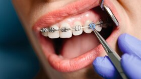 Close up of woman with brackets receiving dental braces treatment in clinic. Orthodontist using dental mirror and forceps while putting orthodontic braces on patient teeth. Concept of dentistry.