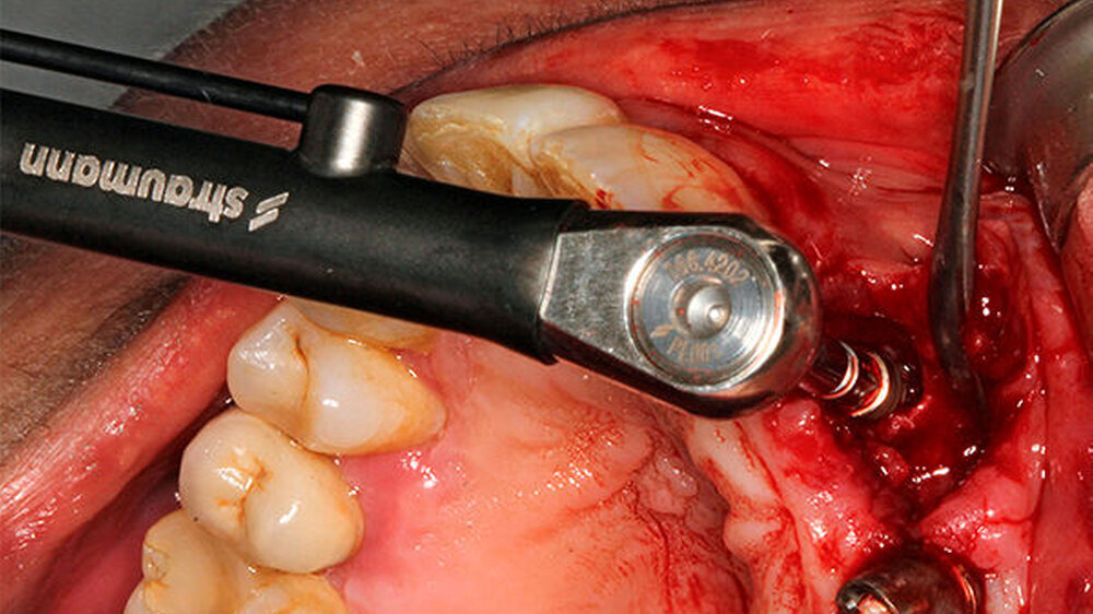 Das Implantat konnte primärstabil eingebracht werden. Die bukkale Knochenwand war erhalten. Es erfolgte keine Augmentation der „jumping distance“.