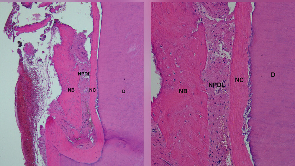 Abb. 1: Humanhistologisches Bild, das die parodontale Regeneration bei einem mit einem Schmelzmatrixderivat (EmdogainÒ) behandelten intraknöchernen Defekt darstellt: Die Bildung von Zement (NC), Desmodont (NPDL) und Alveolarknochen (NB) koronal zu einer