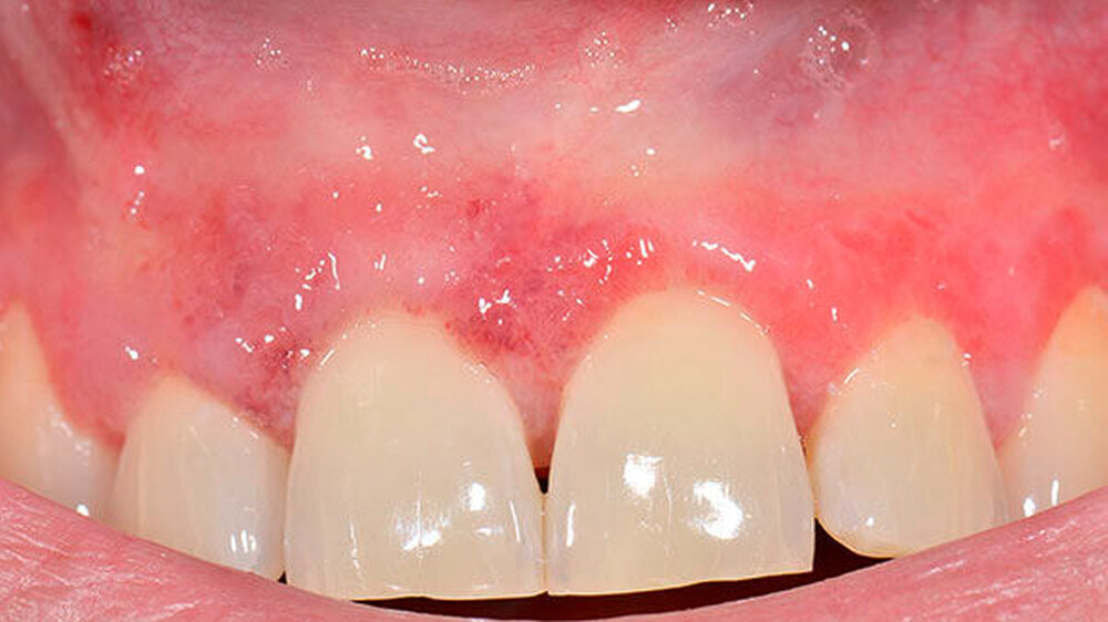 Abbildung 1: Zirkuläre, gerötete Läsionen regio 13–23 mit begleitender Inflammation der vestibulären Gingiva