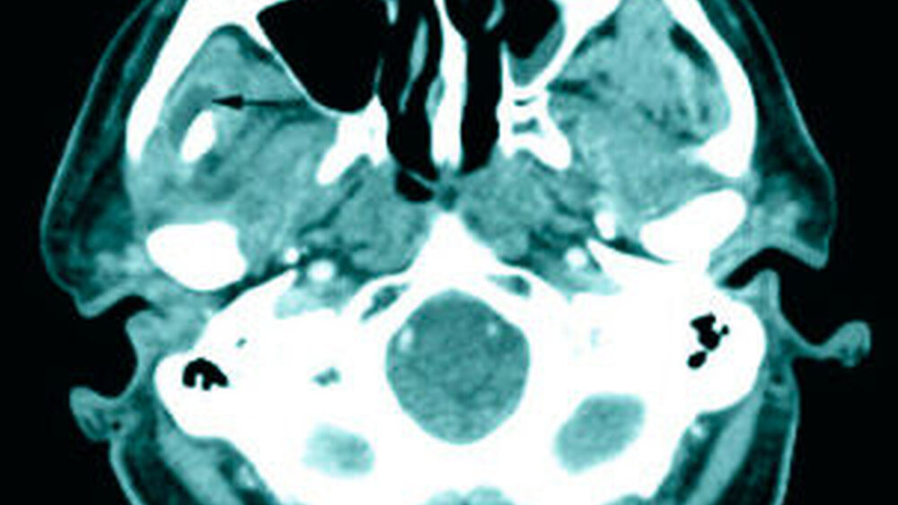 Abbildungen 2a bis 2c: Axiale Schichten aus der Computertomografie nach Abszessspaltung, im Weichteilfenster (a) mit noch nachweisbarem Verhalt im Bereich des Processus muscularis (Pfeile), im Bereich des aufsteigenden Unterkiefer-Astes (b) und im Unterkieferkorpus (c), beide im Knochenfenster: Deutlich zu erkennen sind die alterierte Knochenstruktur mit sklerotischen Veränderungen (besonders in c) und größere Osteolysen (b).(Nebenbefundlich eine Schleimhautschwellung in der linken Kieferhöhle) |