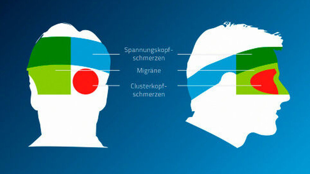 Typische Schmerzlokalisation bei verschiedenen Kopfschmerzformen |