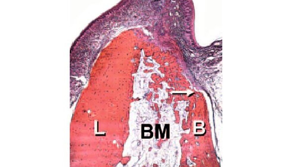 bukkale Resorption im Bereich der Alveole sechs Wochen nach Extraktion