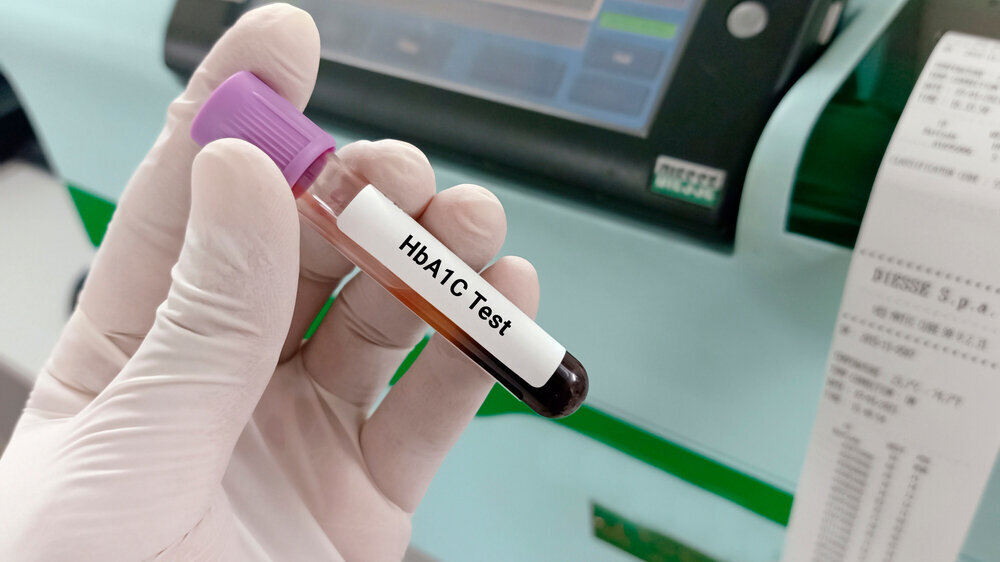 Biochemist or Lab Technologist holds Blood sample for HbA1c (Hemoglobin A1c). Diabetic treatment monitoring test. Medical testing concept. Selective focus on the subject, background blur.
