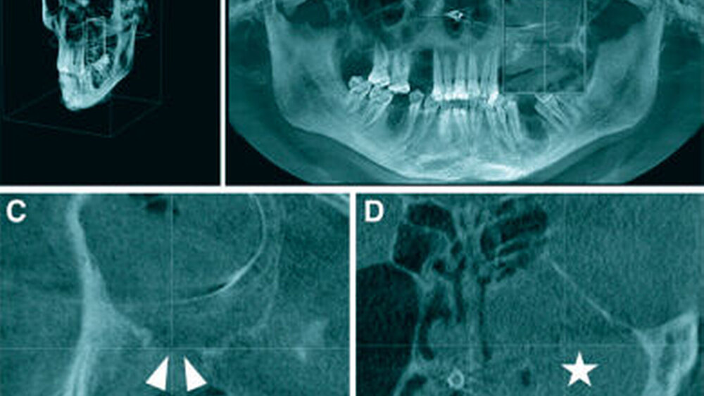 Abbildung 2: A: Übersicht über die 3-D-Rekonstruktion des angefertigten DVT-Datensatzes; B: OPG-Rekonstruktion des DVT-Datensatzes mit persisting alveolar sockets in den regiones 14, 15, 36 und 46, die sich klinisch asymptomatisch ohne freiliegenden Knochen oder Zeichen einer MR-ONJ zeigten; C: Sagittale DVT-Schicht mit Darstellung der großflächigen MAV (weiße Pfeile); D: Koronare DVT-Schicht mit Darstellung des verschatteten sinus maxillaris links (weißer Stern) |