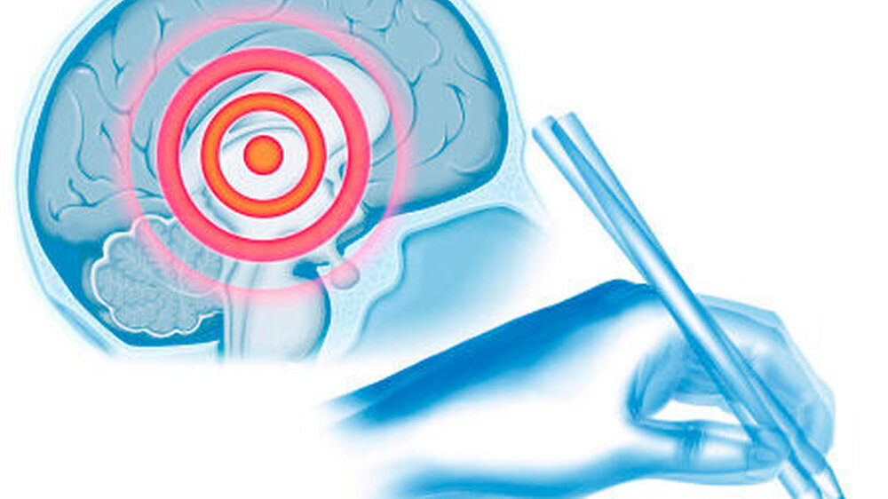 Akinese, Rigor, Tremor – das sind nur die Leitsymptome des Dopaminmangels beim Parkinson.\r\n