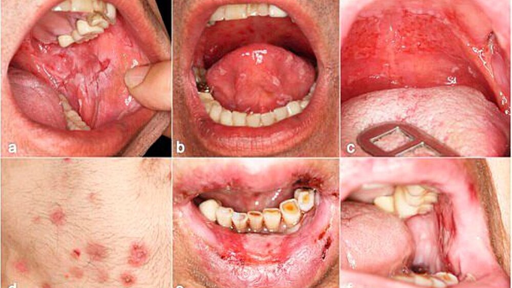 Abbildung 3: Pemphigus vulgaris mit oraler Beteiligung: multiple Erosionen an Wangenschleimhaut (a), Zunge (b) und Gaumen (c); d: mukokutaner Pemphigus vulgaris: Aufgrund des schnellen Abreißens der Blasendecke dominieren Erosionen und Krusten; Paraneoplastischer Pemphigus: ausgeprägte Erosionen an Lippen- (e) und Wangenschleimhaut (f) |