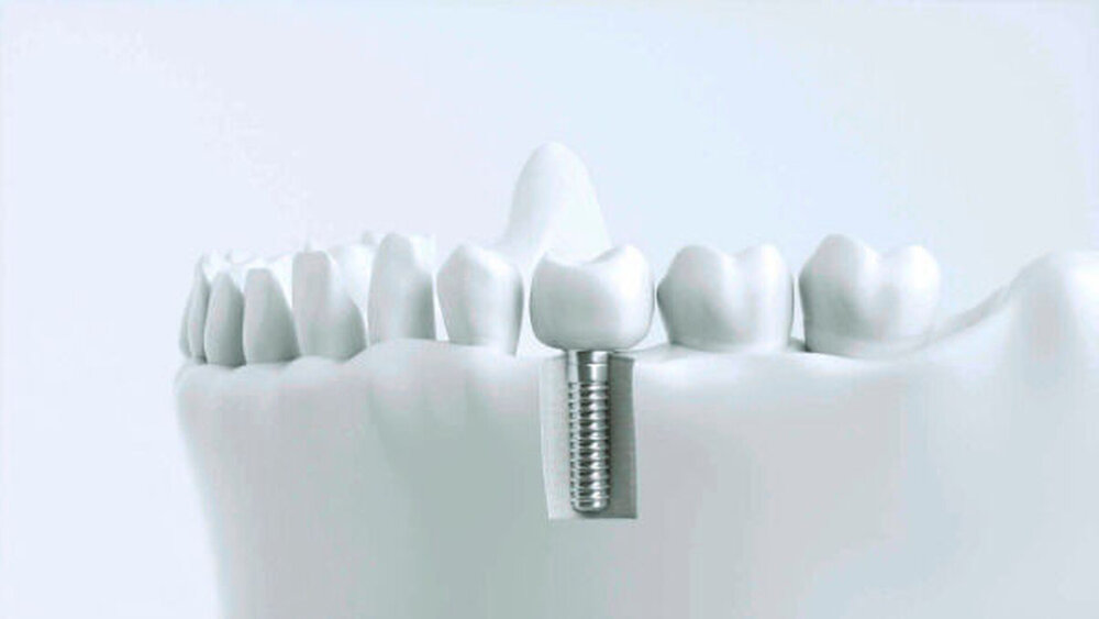 Vorkommnisse mit Implantaten wie zum Beispiel Frakturen von Verbindungselementen oder ähnliches sind meldepflichtig. |