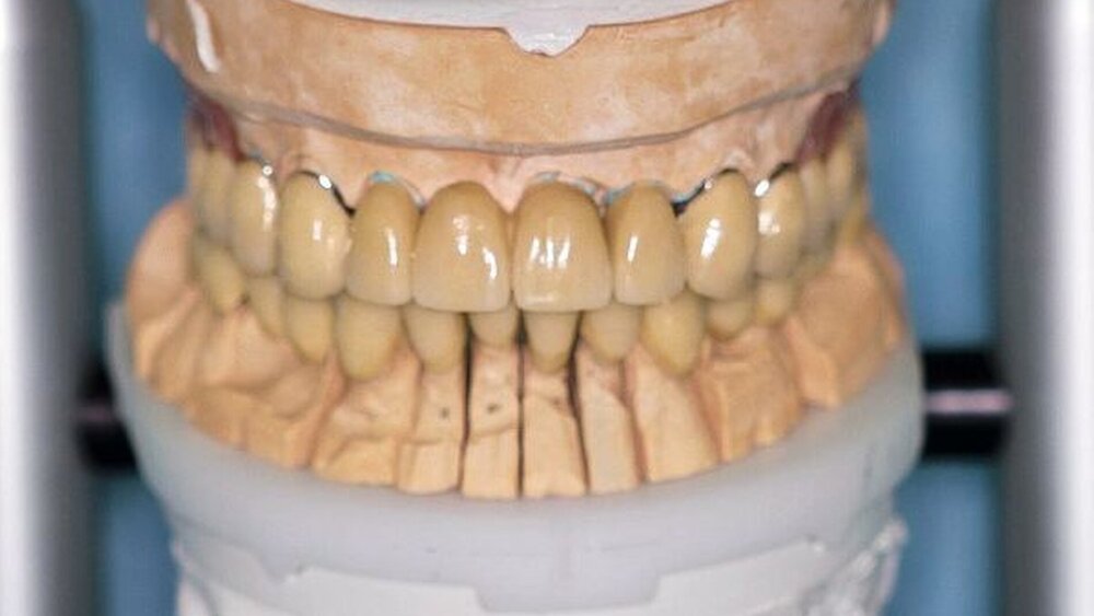 Abbildungen 15a, 15b, 15c: Vollständig verblendete und mit Glasurbrand versehene Kronen und Brücken sowie fertiggestellte partielle obere Prothese vor der definitiven Fixierung. |