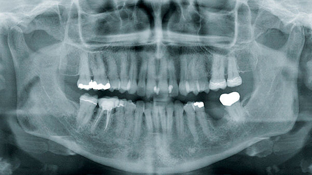 Abbildung 1: Panoramaschichtaufnahme einer Patientin mit sekundär chronischer Osteomyelitis Regio 36: Im Vorfeld war die Extraktion des Zahnes 36 erfolgt. Bei zunächst protrahierter Wundheilung kam es im weiteren Verlauf zu einer lokal unauffälligen Situation. Die Patientin berichtete jedoch über weiterhin vorhandene Schmerzen. Die Panoramaschichtaufnahme zeigt im Vergleich zur Gegenseite nur eine geringe Veränderung im Sinne einer disto-kaudal vom Defekt 36 liegenden, moderaten Sklerosierung. |