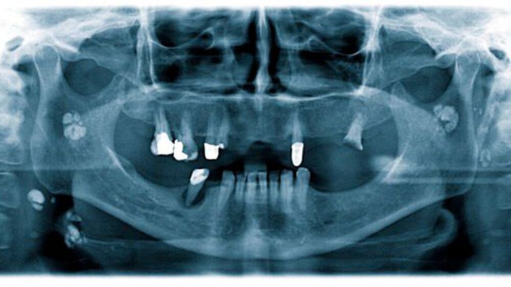 Abbildung 1: Das OPG zeigt multiple bis zu 8x10 mm große Verschattungen in der Kieferwinkelregion und unterhalb des Ramus mandibulae rechts. |