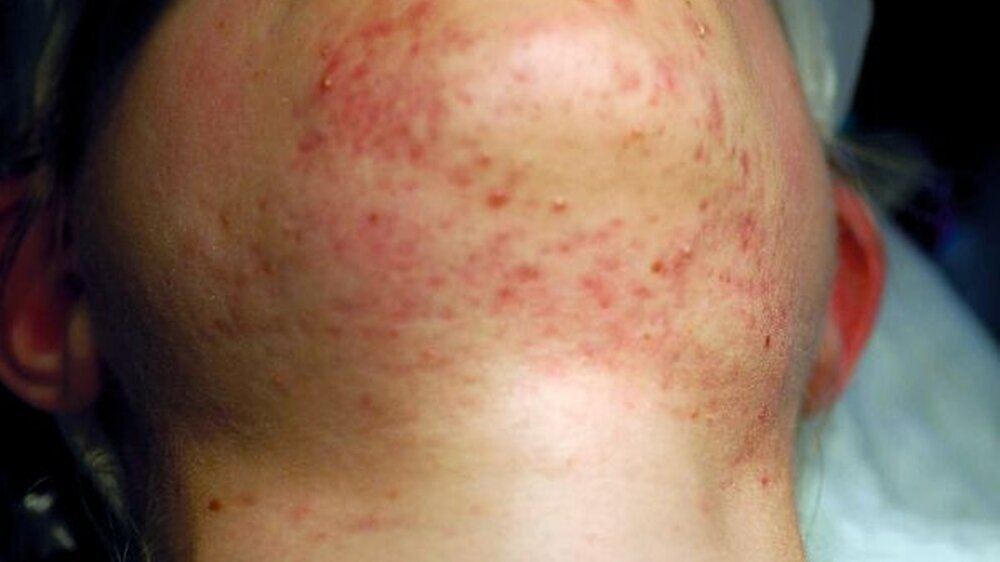 Abbildung 1: Unterkiefer des 16-jährigen Patienten mit Acne vulgaris und Schwellung der rechten Regio submandibularis