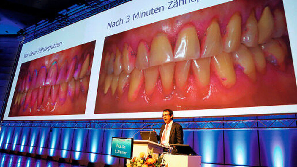 Zähneputzen gilt als Prophylaxemethode Nummer eins. Wie viel Plaque bereits nach dreiminütigem Putzen entfernt werden kann, präsentierte Prof. Dr. Stephan Zimmer (l.), Witten-Herdecke. Wie man eine Schmelzhyperplasie ästhetisch und minimalinvasiv mit Komposit versorgen kann, zeigte Wolfgang Boer, Euskirchen. |