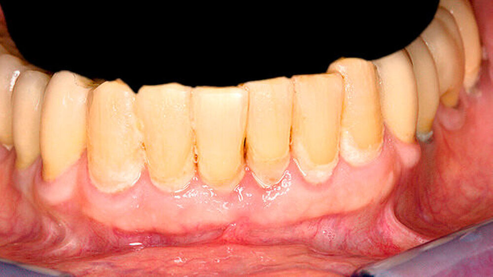 Abbildung 1: Ein häufiges Bild: Anzeichen einer marginalen Gingivitis im Mund des Patienten | Abbildung 1: Ein häufiges Bild: Anzeichen einer marginalen Gingivitis im Mund des Patienten |