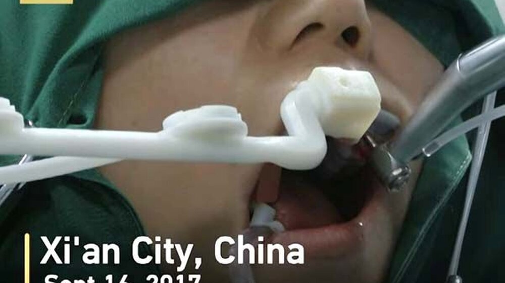Der in China entwickelte und produzierte Roboter implantiert laut Angaben eines Medienberichts mit einer maximalen Abweichung von 0,2 bis 0,3 Millimetern.
