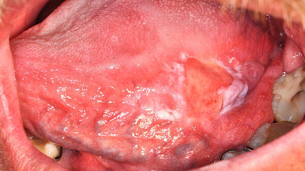 Plattenepithelkarzinom der links-lateralen Zungenseite, das primär als Ulkus aufgrund einer Reizung durch die ipsilateral vorliegende scharfe Zahnkante diagnostiziert wurde | Plattenepithelkarzinom der links-lateralen Zungenseite, das primär als Ulkus aufgrund einer Reizung durch die ipsilateral vorliegende scharfe Zahnkante diagnostiziert wurde |