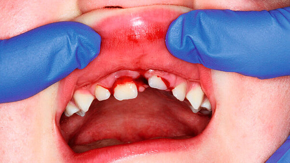 Abbildung 1: Intrusionstrauma an Zahn 21 bei einem siebenjährigen Kind mit circa 3 mm Kranialverlagerung des bleibenden Zahnes 21: Therapiealternativen nach konsentiertem LL-Text: Für drei Wochen auf Spontaneruption warten. Bei fehlender Eruption kieferorthopädische oder chirurgisch unterstützte Extrusion einleiten. Röntgenkontrollen des Zahnes durchführen, bei Resorptionszeichen endodontische Behandlung zunächst mit Ca(OH)2. Bei notwendiger Weichteilversorgung\r\nist die gleichzeitige Reposition des Zahnes 21, gefolgt von flexibler Schienung für zehn Tage, in demselben Eingriff naheliegend und aufgrund der geringen Evidenzlage beim Intrusionstrauma eine ebenfalls gut vertretbare Handlungsoption. |