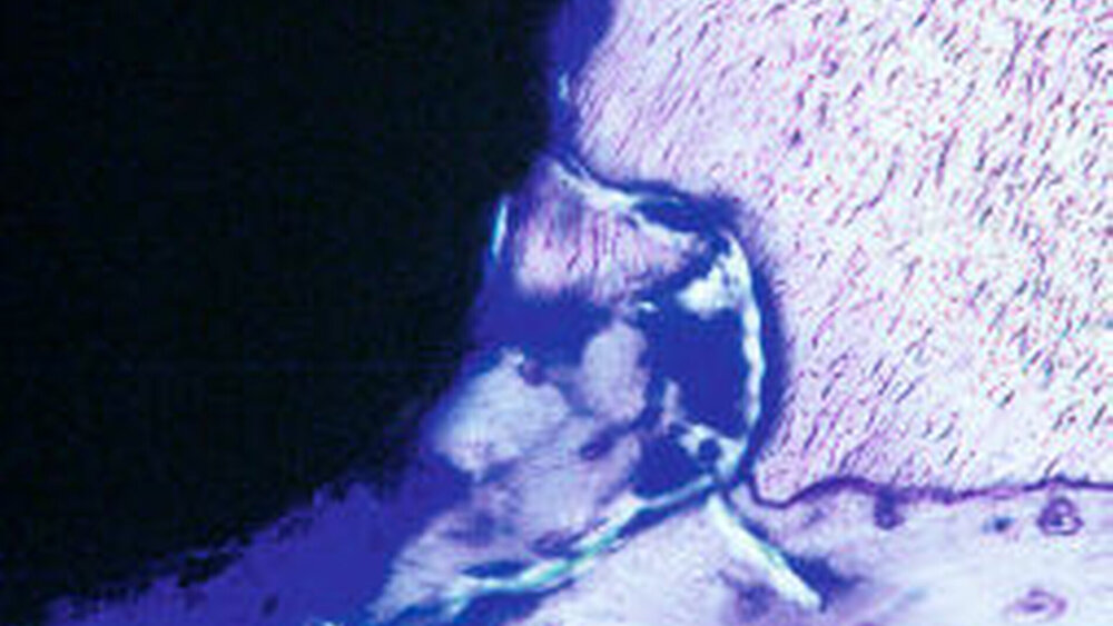 Abbildung 4: Histologische Charakteristika einer Dentointegration, welche vornehmlich durch die Interposition von Osteodentin an der Grenzfläche zwischen Titanimplantat und Zahnwurzel charakterisiert ist (Tiermodell, Toluidin Blau Färbung). |
