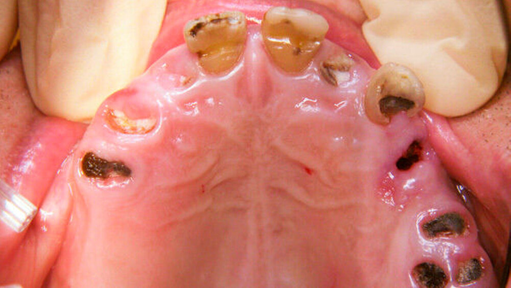 Krasses, aber gar nicht so seltenes Beispiel einer Gebisssituation eines Pflegeheimbewohners: Würden Sie die Wurzelreste entfernen oder würden Sie diese im Zahnbett belassen? |