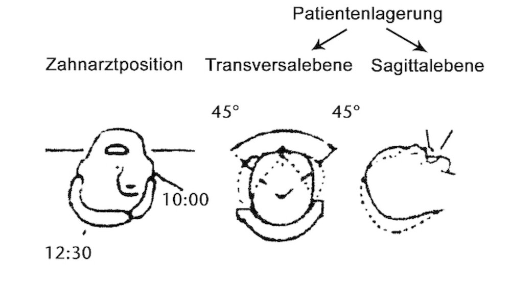 Abbildung 6: Die für die Arbeitsvorgänge an den verschiedenen Kanälen notwendigen Positionsänderungen des Zahnarztes und Haltungsänderungen des Patientenkopfes bei Positionierung des Arbeitsobjekts in der individuellen Arbeitshöhe. |