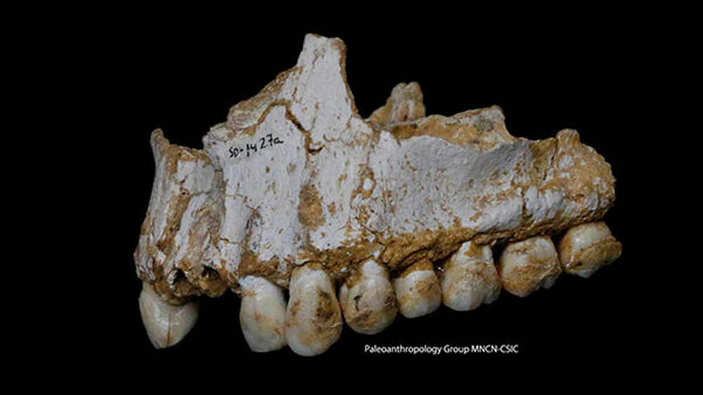 Eine Zahnsteinablagerung ist auf dem hinteren Molaren (rechts) eines Neandertalers aus Spanien sichtbar. Dieser Neandertaler verspeiste salicylsäurehaltiges Pappelholz, um Schmerzen zu stillen. Auch die DNA eines Schimmelpilzes, der antibiotisch wirkt, w