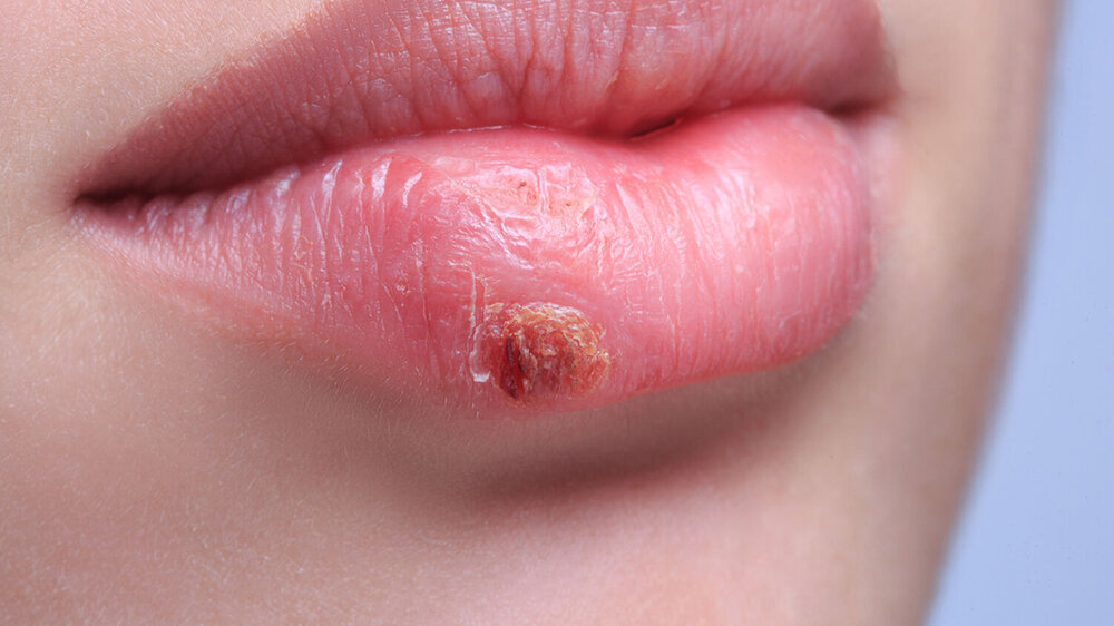 Im Labor gelang es dem Forscher-Team, Herpes-infizierte Gehirn-Organoide durch die Gabe von Interferon Typ 1 vor Fehlbildungen zu schützen.