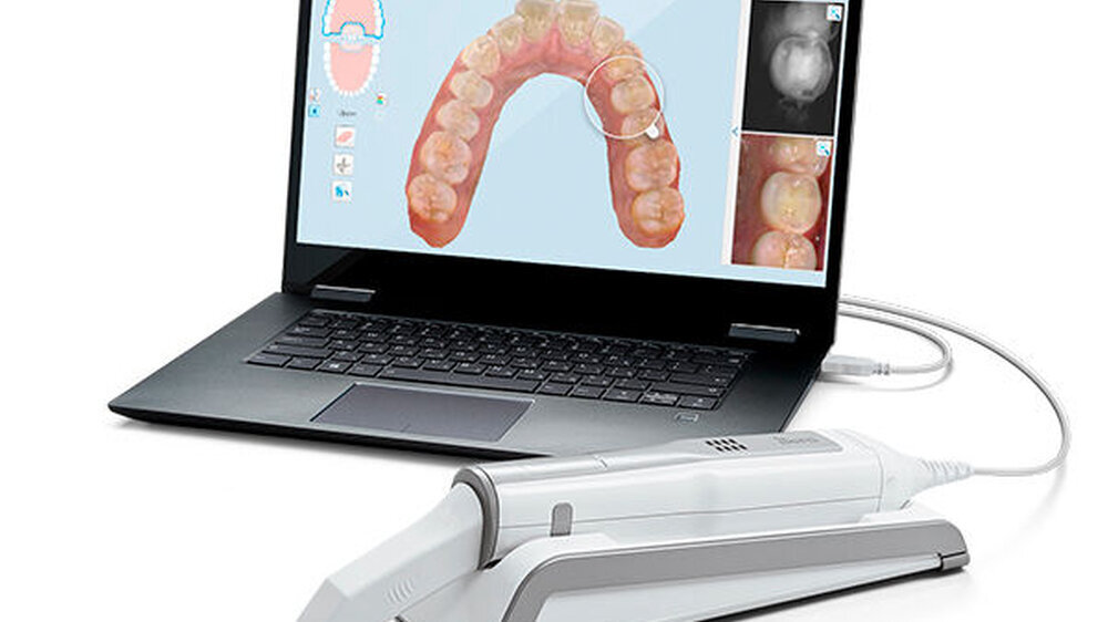 Der iTero Element 5D Intraoralscanner von Align Technology bietet gleichzeitig Aufnahmen in 3D, intraoraler Farbe und Nahinfrarot (NIRI) zur digitalen Erkennung von Kariesläsionen.