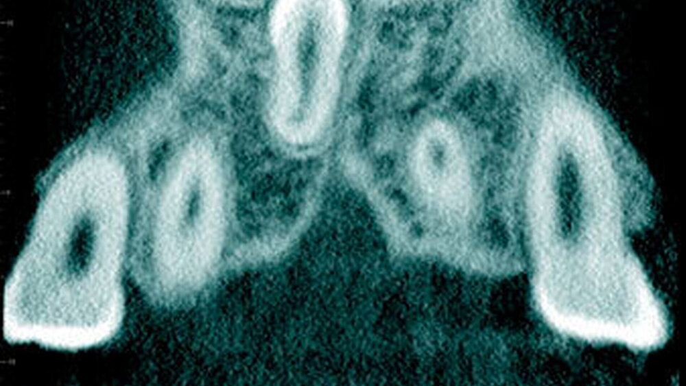 Abbildung 20: Überzähliger Zahn im Oberkieferfrontbereich (Mesiodens) mit einer konischen Form bei einem elfjährigen Mädchen mit Durchbruch in die Nasenhöhle (a: koronales Schnittbild der digitalen Volumentomographie). |