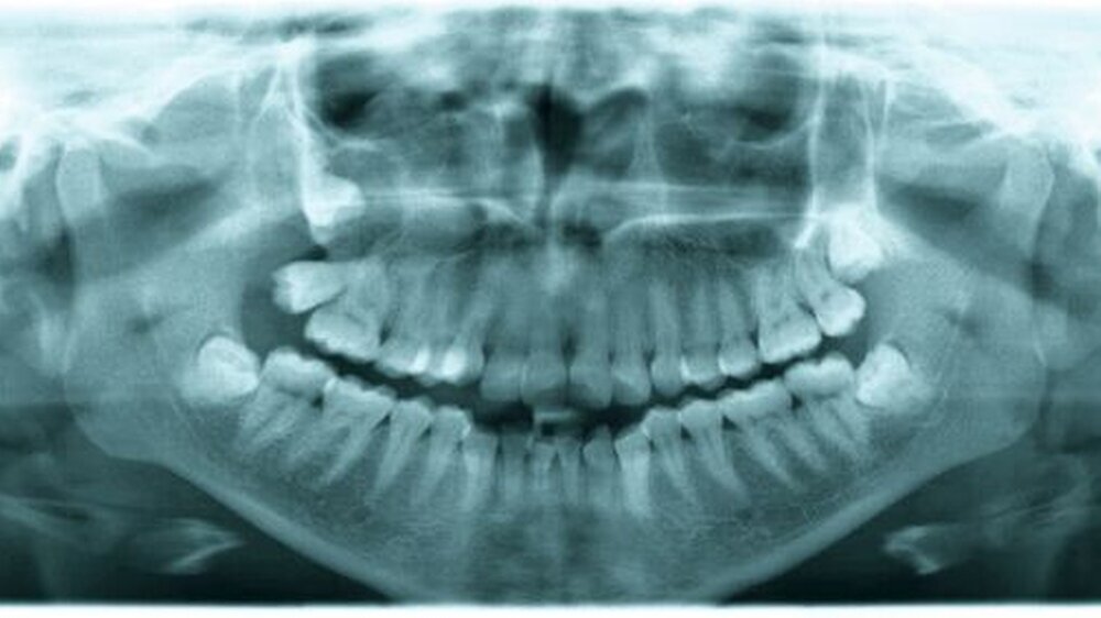 Abbildung 1: Präoperatives Orthopantomogramm mit Verschattung der rechten Kieferhöhle und dem in eine zystische Struktur eingebetteten, hochverlagerten Zahn 18. Der Zahn 17 kommt nach distal gekippt zur Darstellung. |