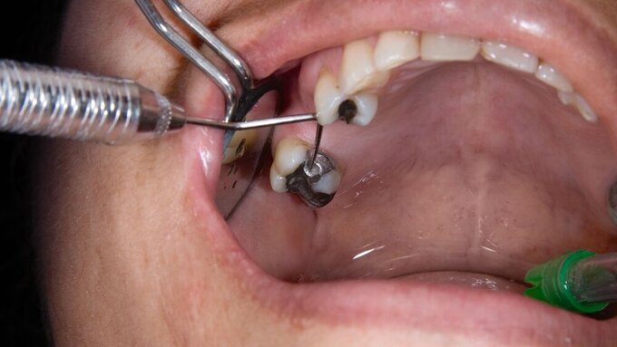 protesis parcial removible Amalgam