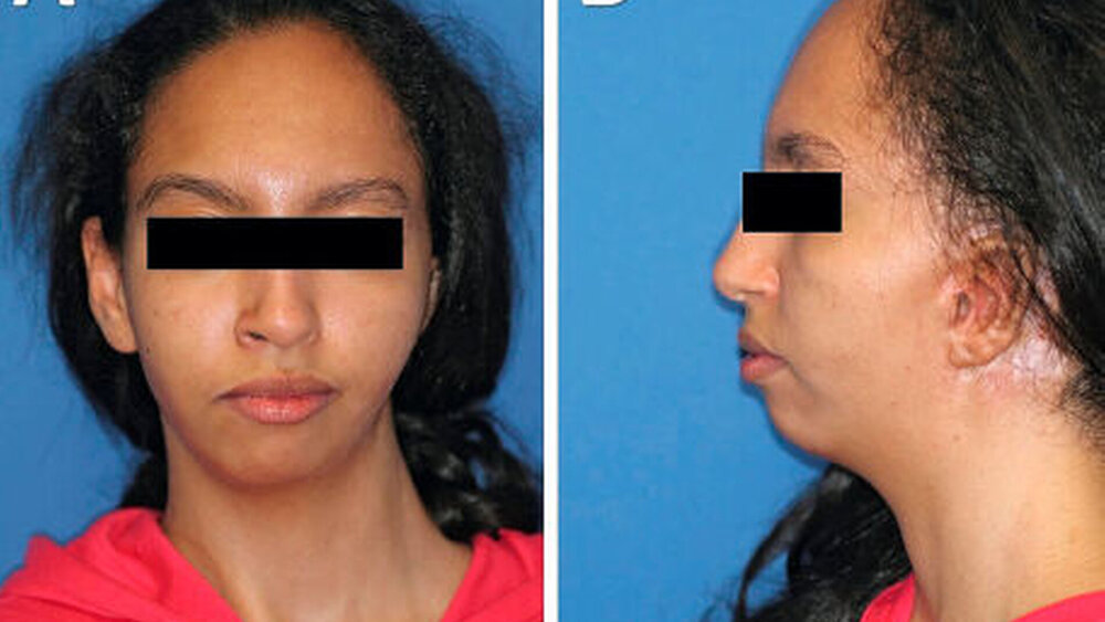 Abbildung 1: Patientin mit dem Goldenhar-Syndrom nach monognather Umstellungsosteotomie neun Monate vor der Konsultation von frontal (A) und von links sagittal (B) |