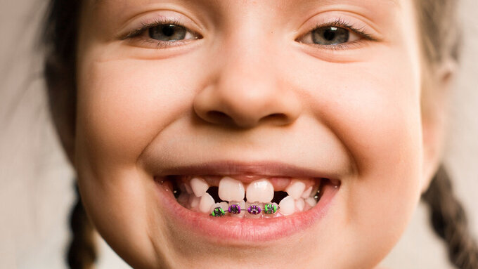 Mädchen mit Brackets