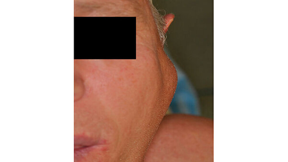 148644-flexible-1900 Abbildung 2: Klinisches Bild der Patientensituation in kranio/kaudaler Richtung: Es imponiert ein circa 3 cm x 2 cm umfassender Lokalbefund am kaudalen Parotispol. |